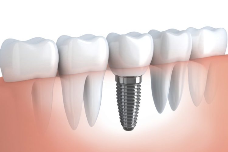 dental-implants