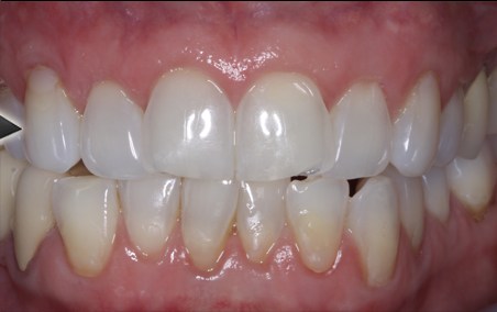 Can Receding Gums Be Reversed