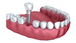 Dental Implants CA