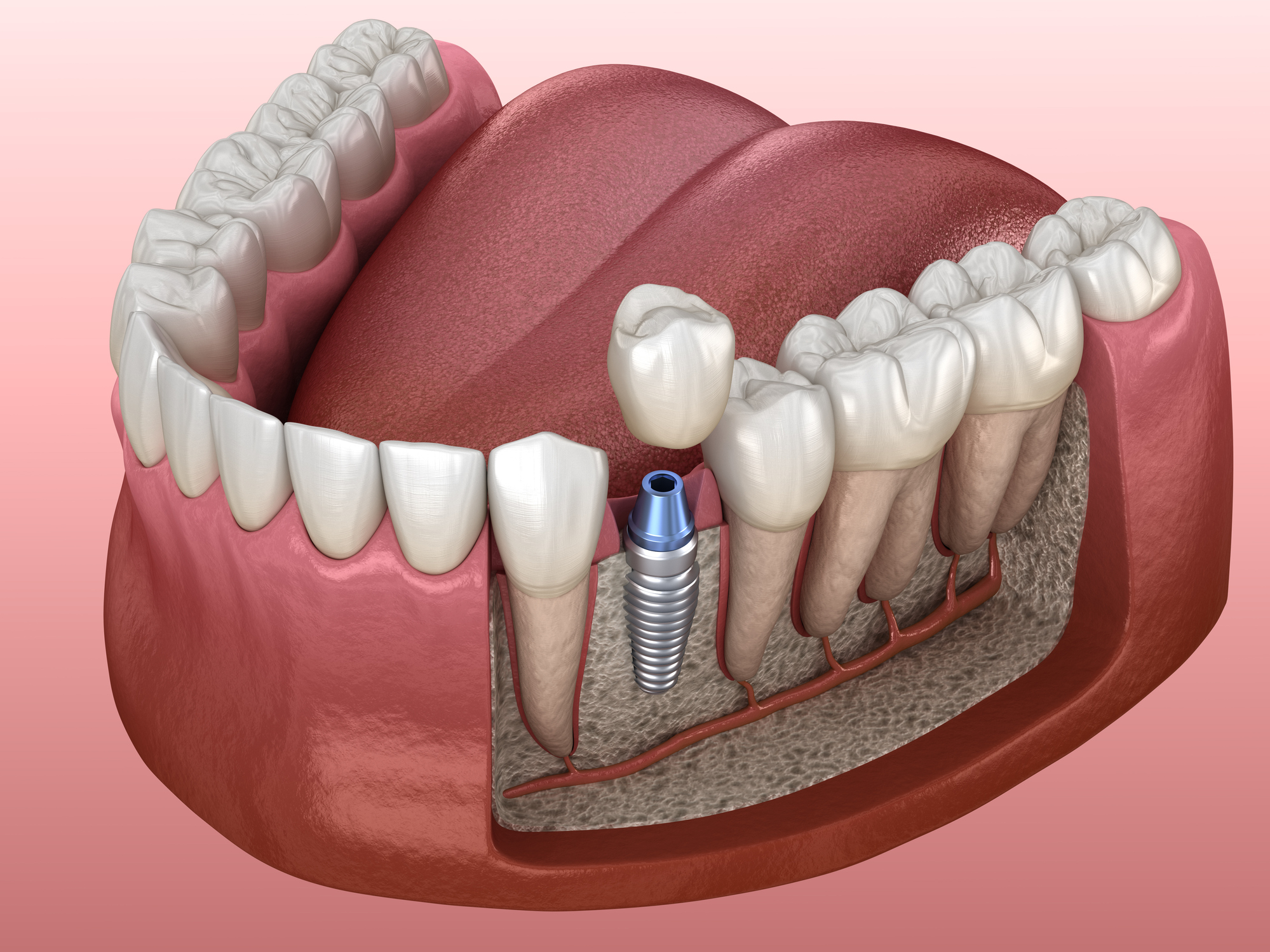 Are dental implants an option if you have severe bone loss?